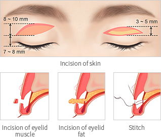Blepharoplasty korea