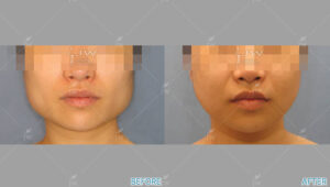 Before After Face Contouring In Korea