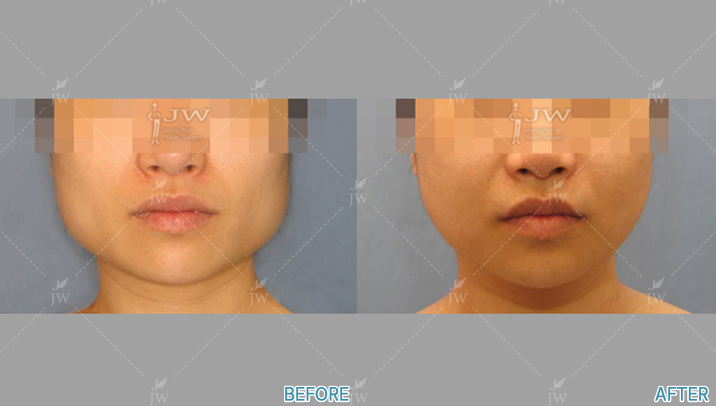 Before After Face Contouring In Korea
