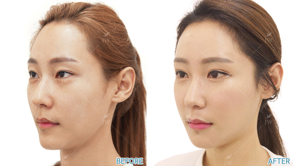 Before After Face Contouring In Korea