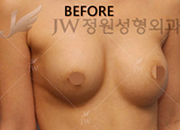 breast-revision-surgery-jw-plastic-surgery-clinic-1ar