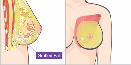 breast-stem-cell-graft-augmentation-jw-3