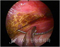 breast4_img7