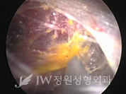 breast4_img8