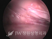 breast4_img9