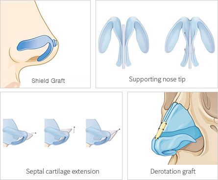 derotation-graft-for-tip-plasty-using-ear-cartilage-tip-extension-1