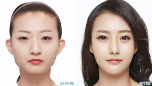 Before After Face Contouring In Korea