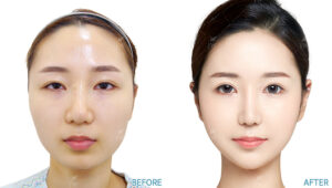 Before After Face Contouring In Korea
