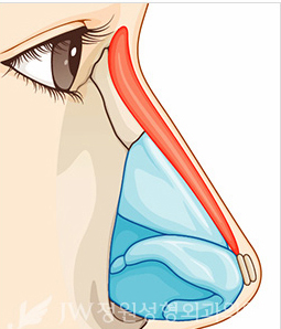 hump-nose-surgery-korea-3
