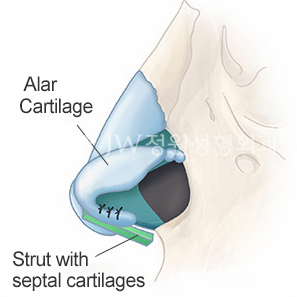 long-nose-correction-surgery
