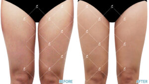 plastic surgery body contouring korea