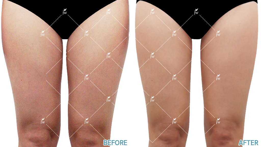plastic surgery body contouring korea